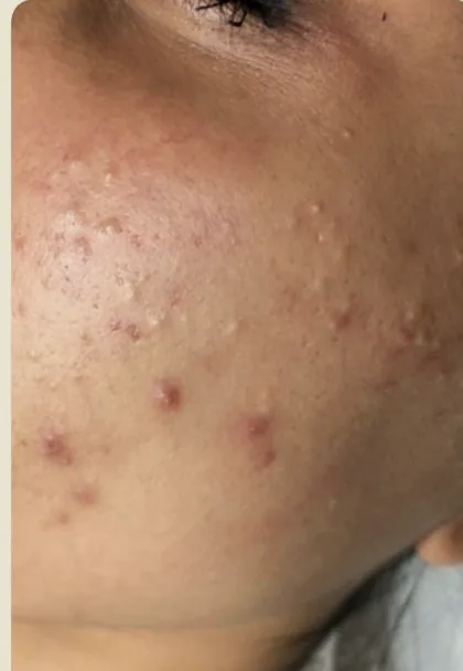 An active acne breakout across a female patient's cheek before laser skin resurfacing at The Hampton Clinic