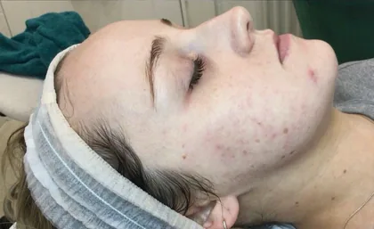 The same patient after laser skin resurfacing at The Hampton Clinic, with the acne calmed
