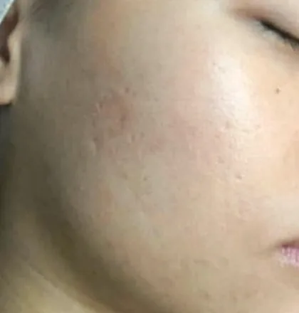 The same cheek after laser skin resurfacing at The Hampton Clinic, calmer and clearer