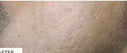 The same cheek after laser skin resurfacing at The Hampton Clinic, with smoother texture