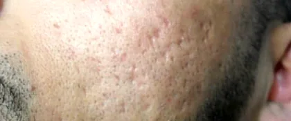Acne scarring across a male patient's cheek before laser skin resurfacing at The Hampton Clinic, Bristol