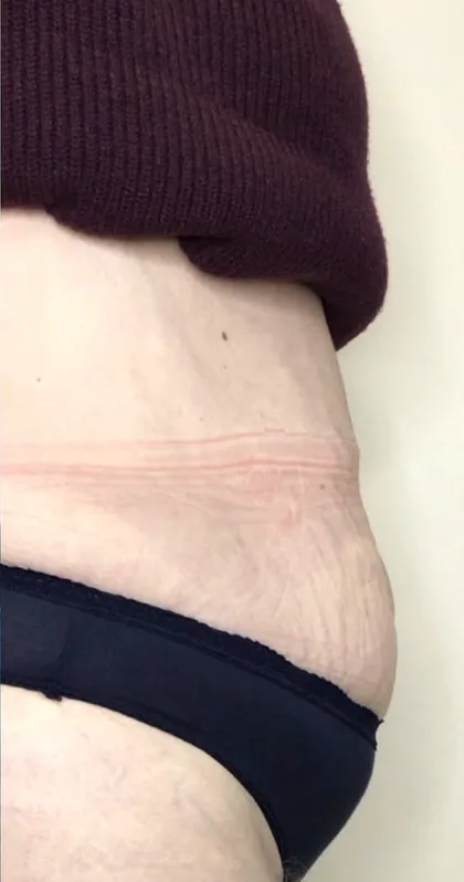 A patient of the clinic after a body contouring programme, published with consent