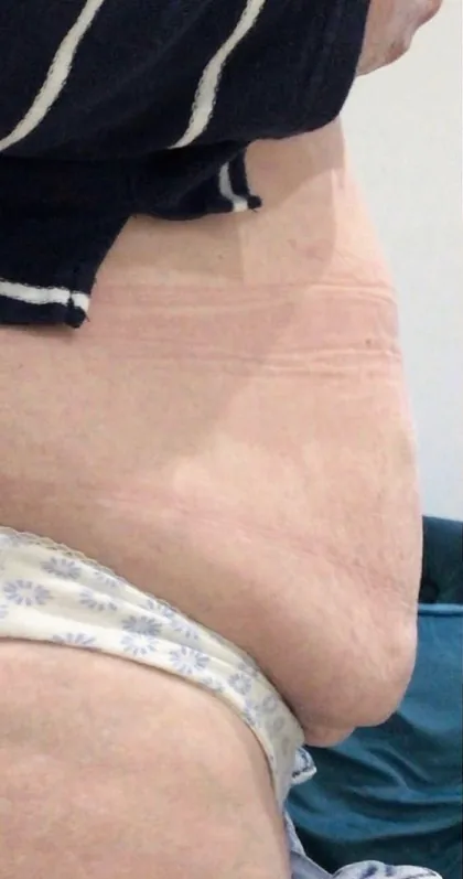 Abdomen photographed in profile before a body contouring programme at The Hampton Clinic