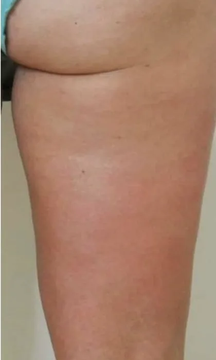 The same upper thigh after a body contouring programme, with the appearance of cellulite reduced