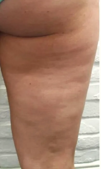 Upper thigh showing dimpling and uneven texture before body contouring treatment