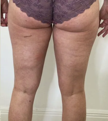 The same patient after a body contouring programme, with visibly smoother rear thighs