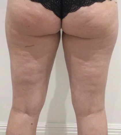 Female patient rear thighs photographed before body contouring treatment at The Hampton Clinic