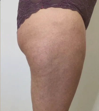 A patient of the clinic after a body contouring programme, published with consent