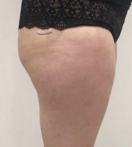 Female patient outer thigh and hip photographed before a course of body contouring at The Hampton Clinic