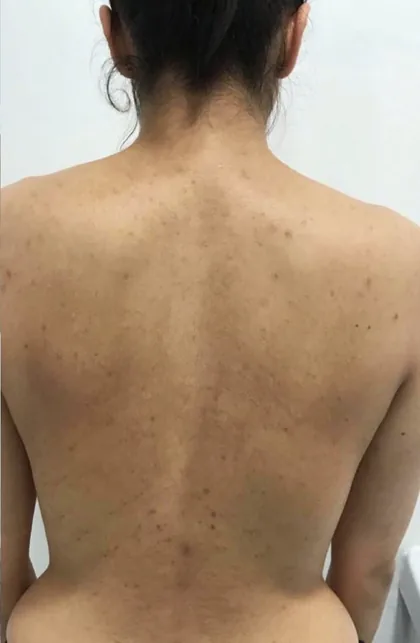 The same back after a course of laser hair removal at The Hampton Clinic, clearer and more even