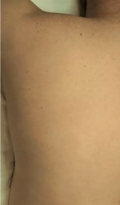 The same back after a course of laser hair removal at The Hampton Clinic, with the hair reduced