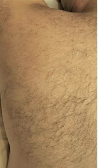 A male patient's back with dense hair before a course of laser hair removal at The Hampton Clinic, Bristol