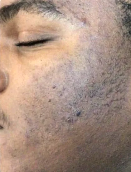 The same cheek after a skin plan at The Hampton Clinic, with fewer marks and a more even tone