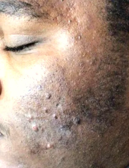 Post inflammatory marks on the cheek of a patient with a deeper skin tone before treatment at The Hampton Clinic