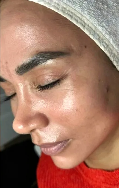 The same patient after a pigmentation plan, with the cheek melasma faded