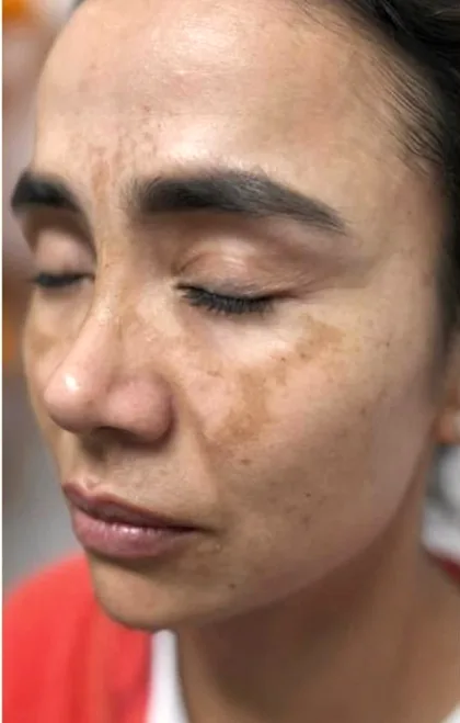 Melasma across the cheeks of a female patient before treatment at The Hampton Clinic, Bristol