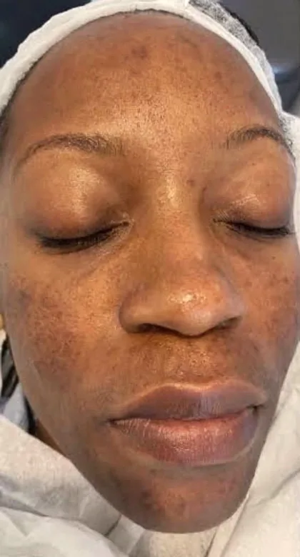 Melasma across the cheeks of a female patient with a deeper skin tone before treatment at The Hampton Clinic