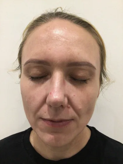 The same patient after a pigmentation plan at The Hampton Clinic, with the forehead melasma faded
