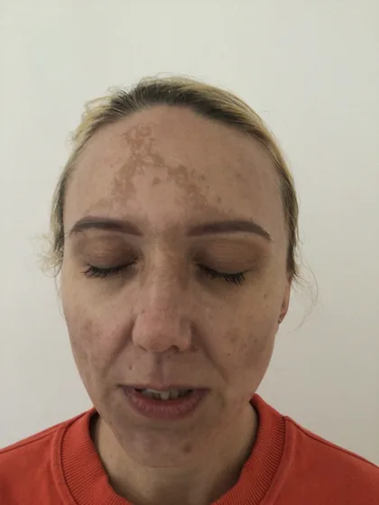 Melasma across the forehead of a female patient before treatment at The Hampton Clinic, Bristol