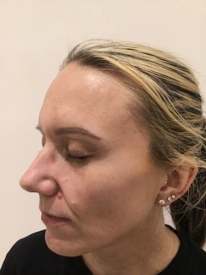 The same view after a pigmentation plan, with the melasma visibly reduced