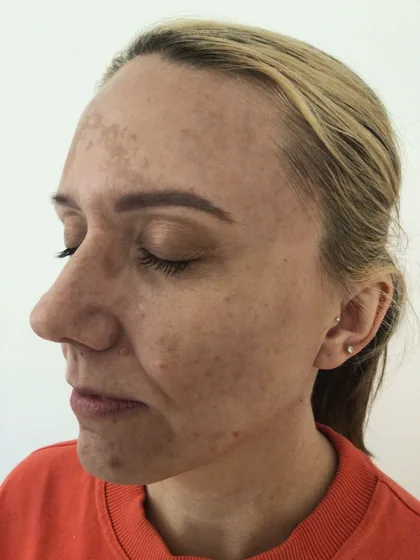 Forehead melasma seen from the left before treatment, The Hampton Clinic Bristol