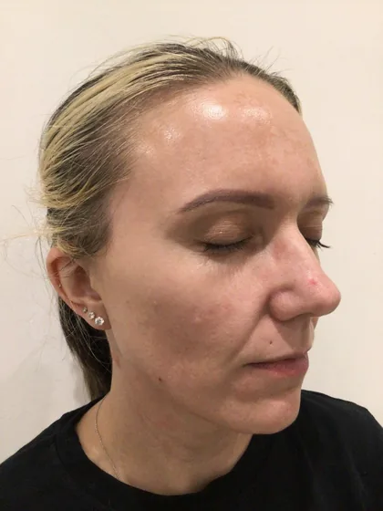 The same view after a pigmentation plan, with the melasma visibly reduced