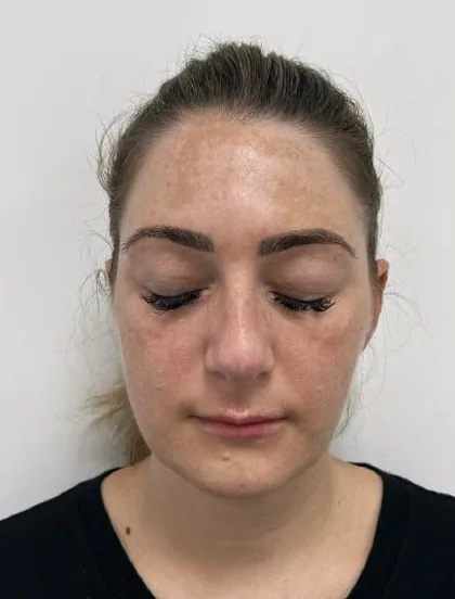 Freckling and uneven tone across the face of a female patient before treatment at The Hampton Clinic, Bristol
