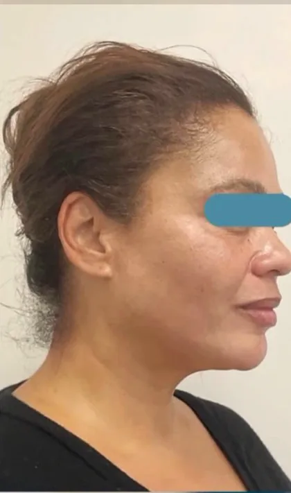 The same profile after a pigmentation plan, with a more even cheek