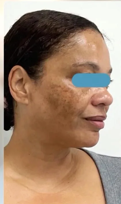 Melasma across the cheek of a female patient in profile before treatment at The Hampton Clinic